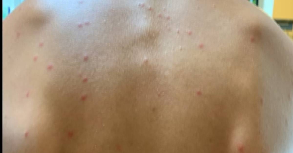 Swimmers Itch Popping Up Around Northern Michigan 9&10 News